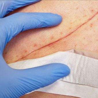 Management-of-surgical-wound-infection_735x490